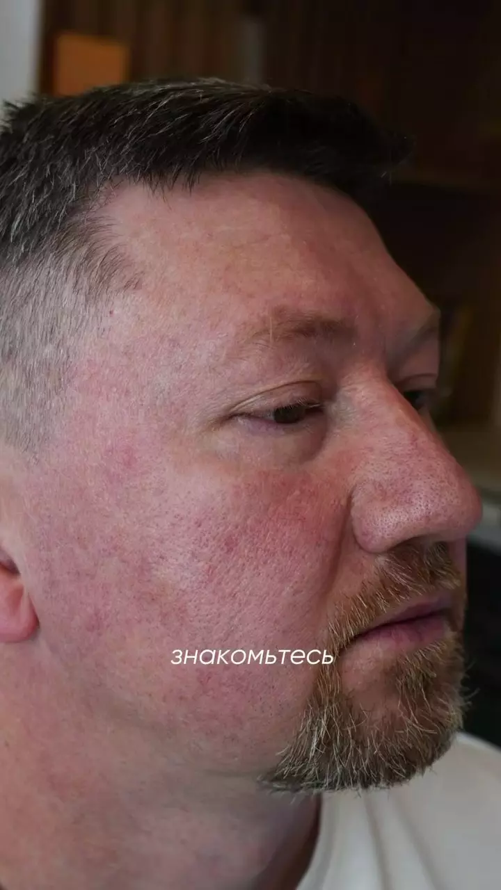 Когда постоянная краснота кожи — это уже не просто особенность, а проблема, с которой хочется