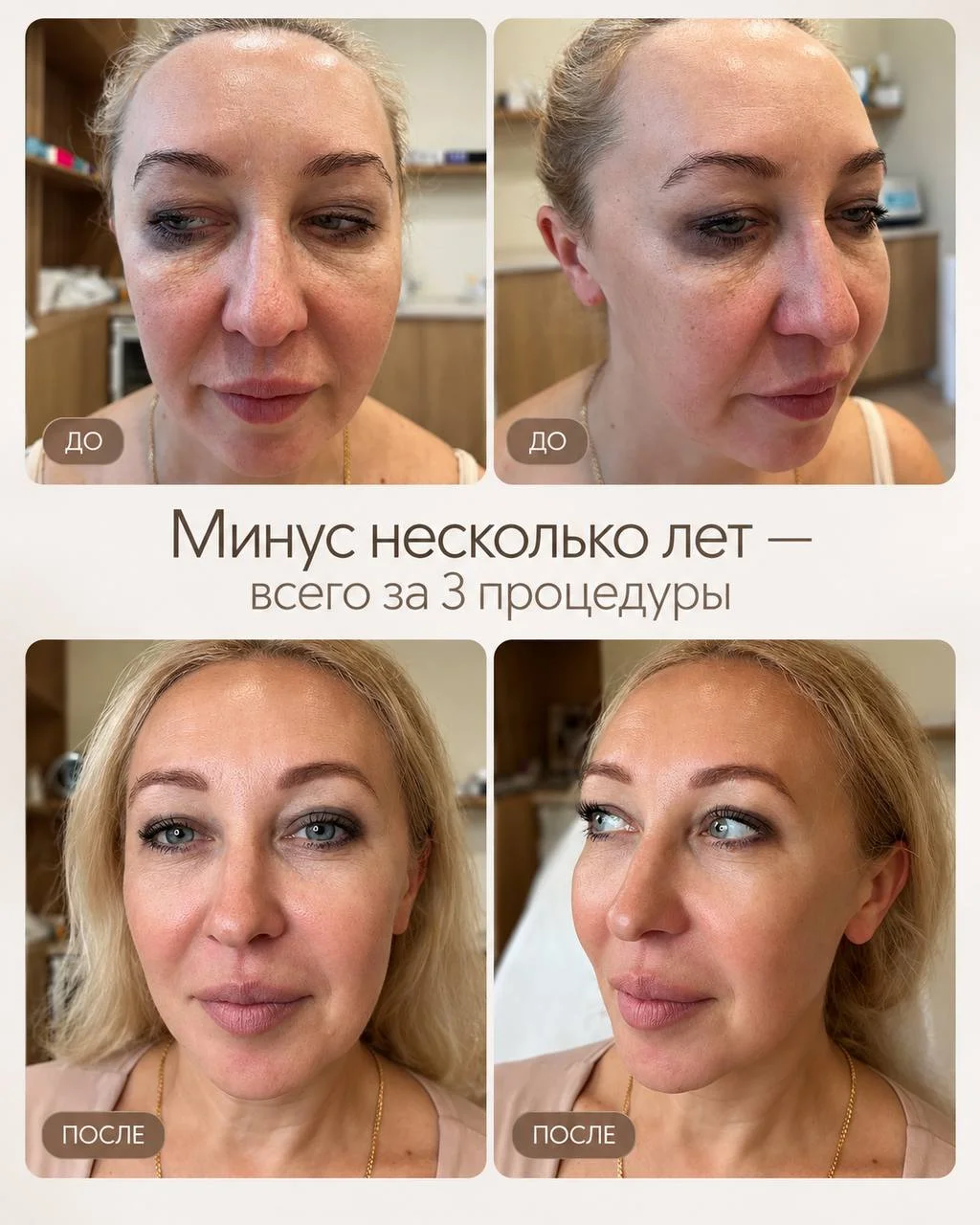 Минус несколько лет — всего за 3 процедуры ✨