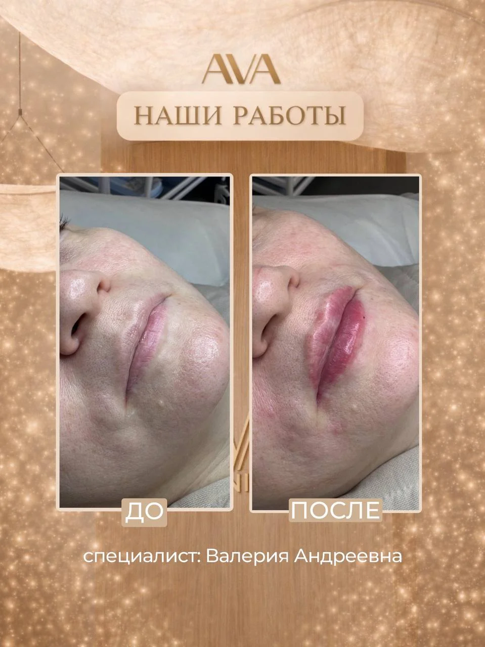 Сегодня мы хотим показать вам работы по контурной пластике губ, которыми по-настоящему гордится