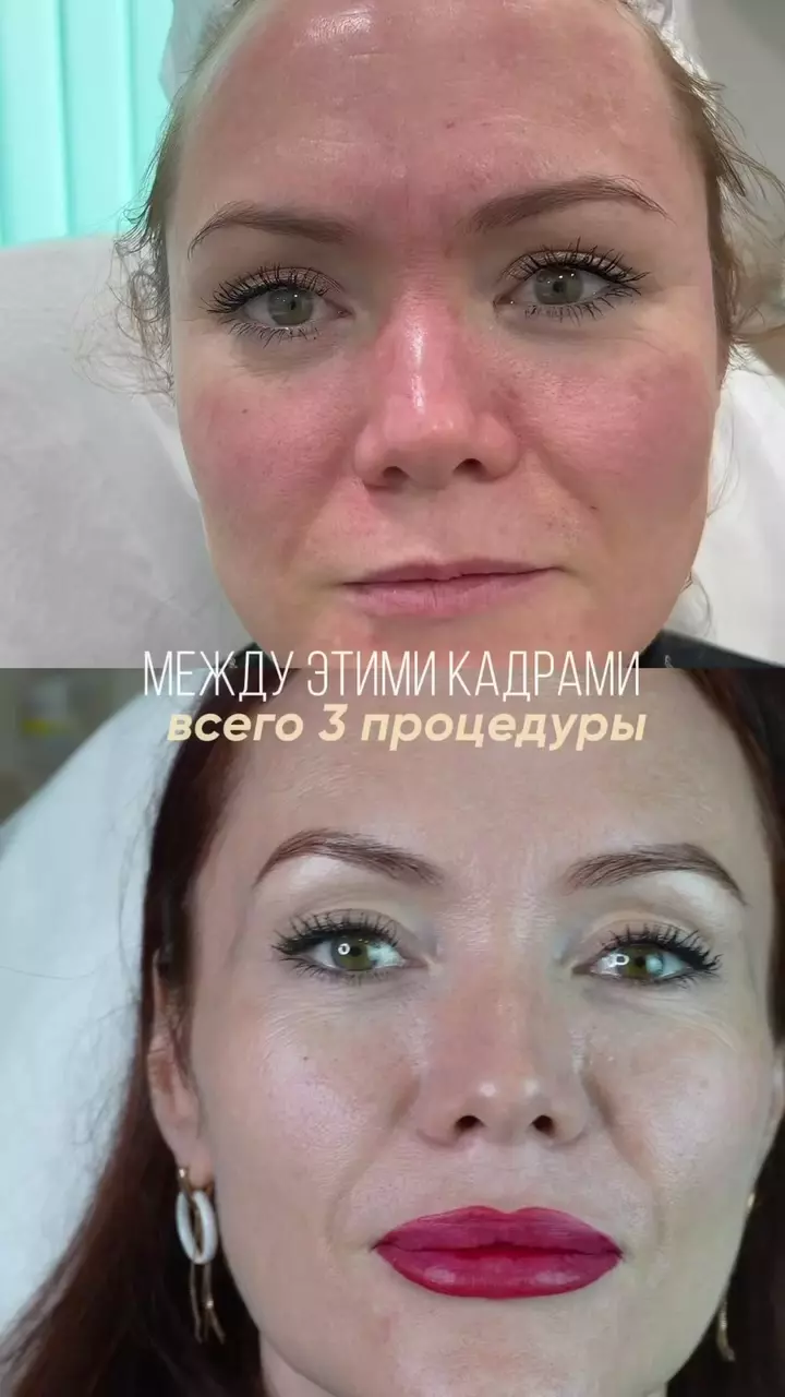 Вы не поверите, насколько может измениться лицо всего за несколько правильно подобранных процедур 👀